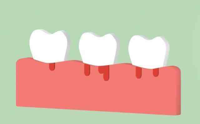 牙齿一吸就出血是癌症？不至于，但若是这3种，就不得不重视了