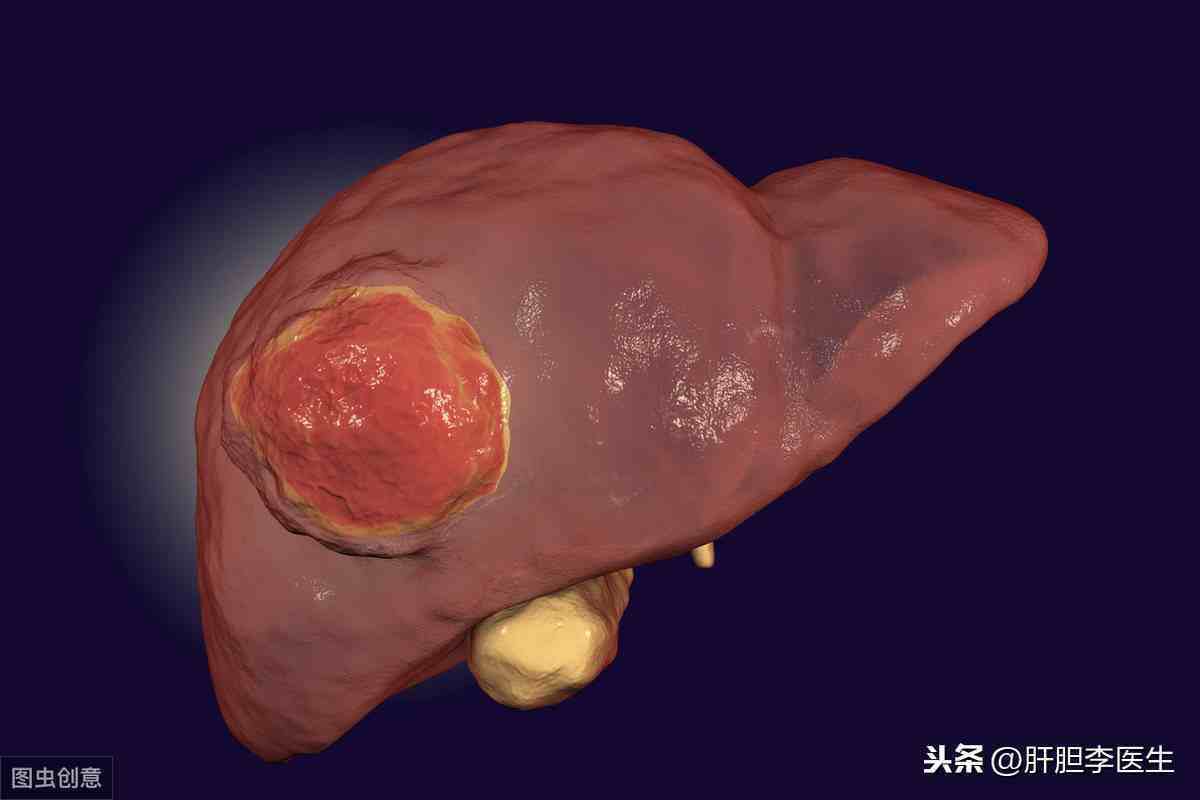 肝癌靶向治療費用讀懂肝癌的靶向治療