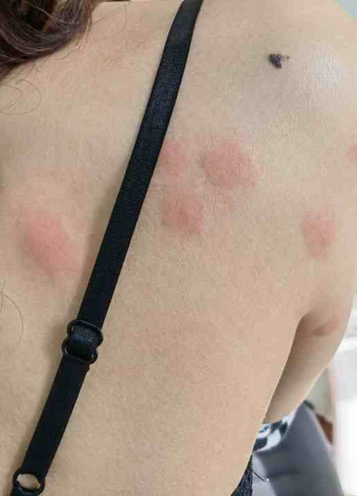 虫咬皮炎、丘疹性荨麻疹的治疗与预防