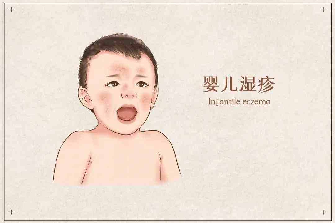 婴儿湿疹中药（宝宝得了湿疹怎么办？）