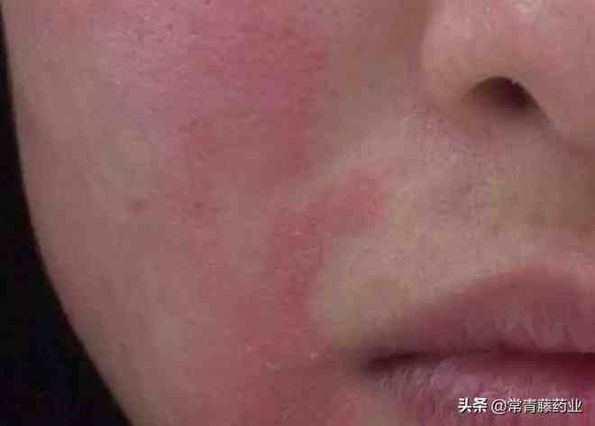 面部皮炎应该怎么治疗预防，激素药膏可以抹在脸上吗？