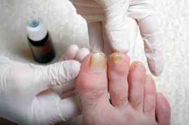 你知道脚指甲呈黄色的原因是什么吗？如何预防及治疗？