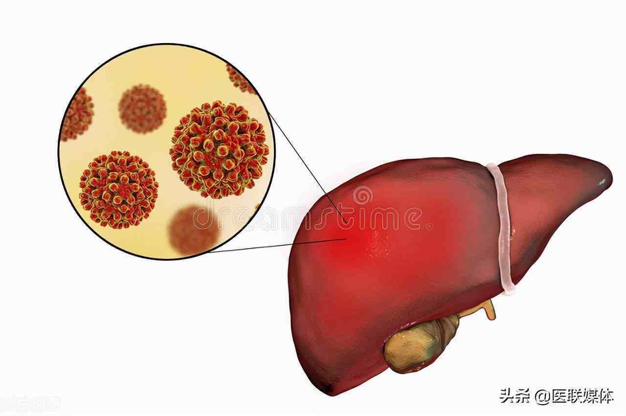 脂肪肝反复发作怎么办？若想肝脏健康，这3种食物少吃些