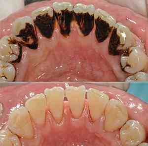 牙黄变白的方法（牙齿发黄是什么原因导致的？）