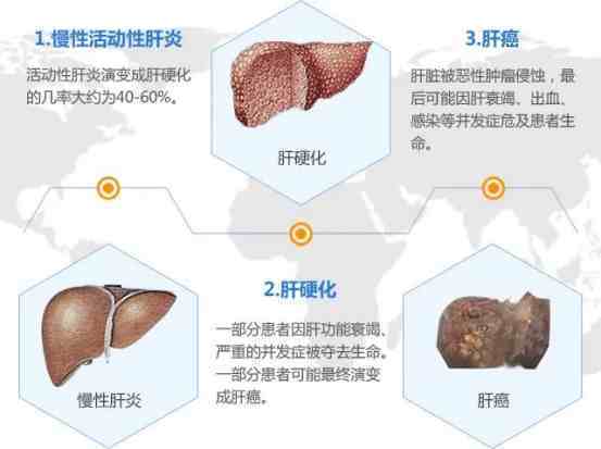 肝硬化是由一種或多種病因長期反覆作用於肝臟而形成的慢網性,進行性