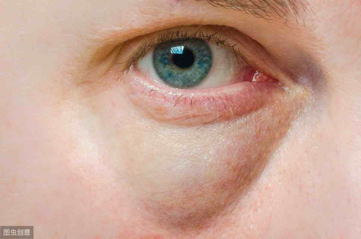 眼睛浮肿是怎么回事？5大诱因全部“榜上有名”，要小心防范
