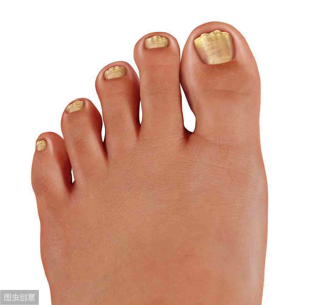 脚指甲变黄变厚的原因