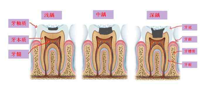 根管治疗需要多久(一颗牙齿根管治疗需要多长时间)