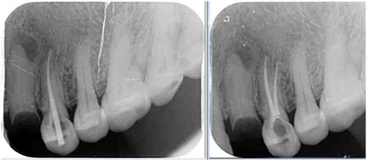 根管治疗需要多久(一颗牙齿根管治疗需要多长时间)