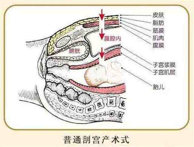 剖宫产图解图片