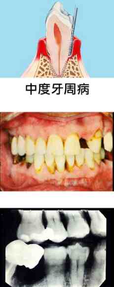 牙龈修复手术多少钱(牙龈萎缩手术利与弊)