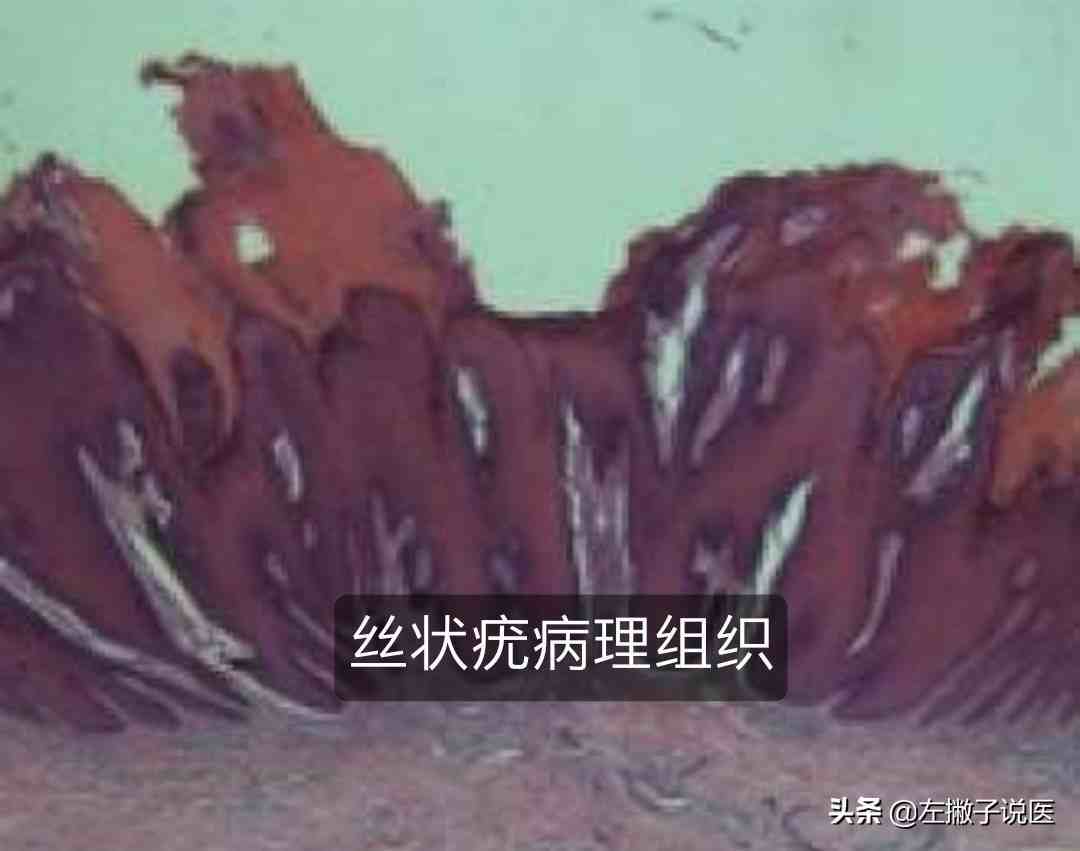 而長這種被稱為絲狀疣的