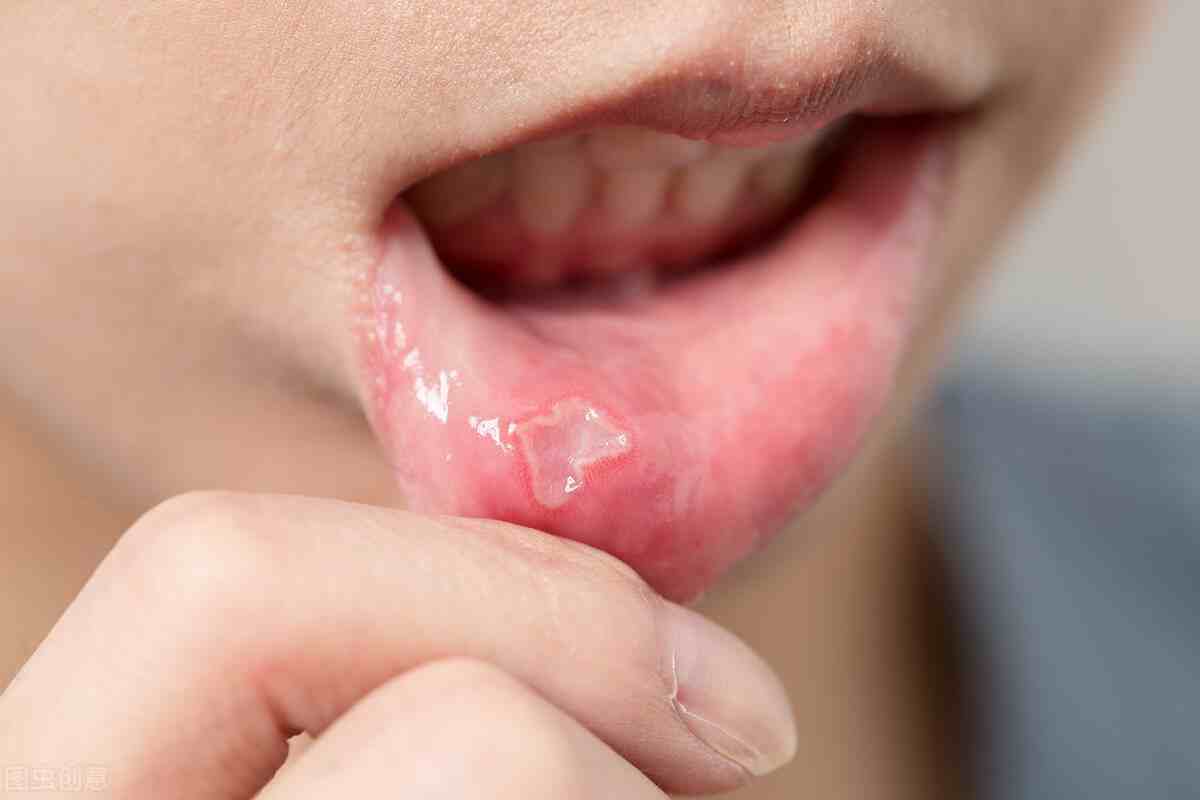 口腔溃疡反复发作，有什么特效药？