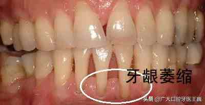 全中国有一半的人都会牙龈萎缩，有这几种症状的要注意了