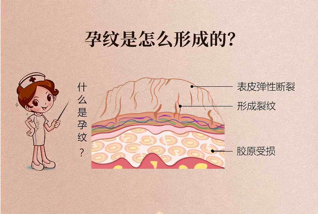 如何预防妊娠纹预防妊娠纹最好的方法