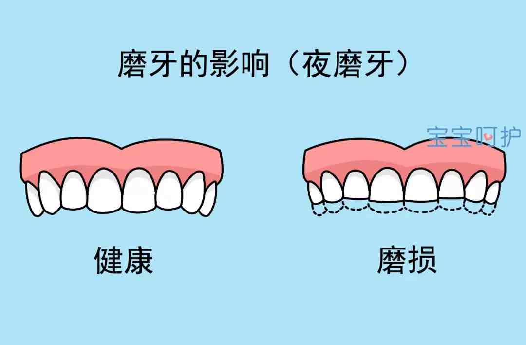 晚上睡覺磨牙怎麼治療長期夜間磨牙該怎麼治