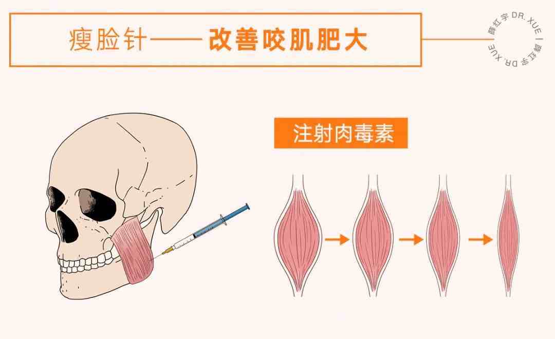 下巴肥大是怎么回事图片