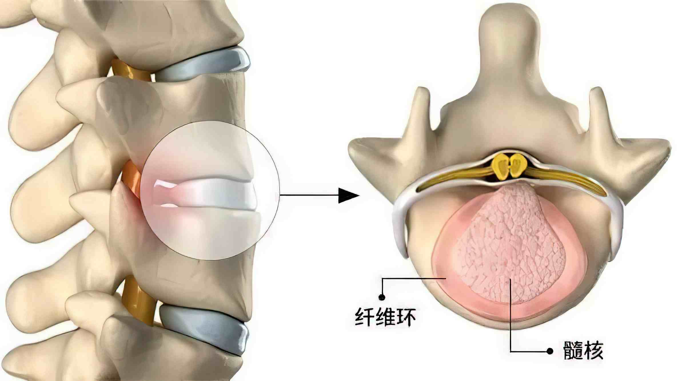 腰椎曲度變直怎麼辦腰椎間盤膨出最佳治療