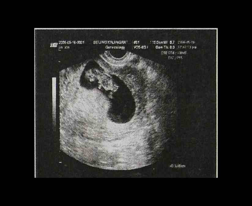 一个孕囊双胞胎彩超图图片