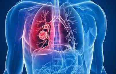肺癌的分型分期及预后