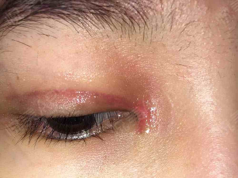 眼角疤痕增生多久能消失？