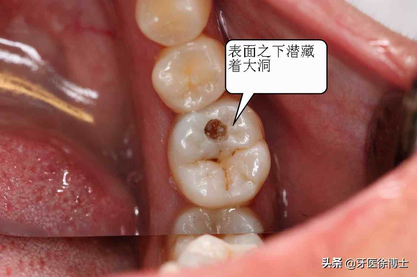 蛀牙不疼的情况下要补吗？补牙能用多久？