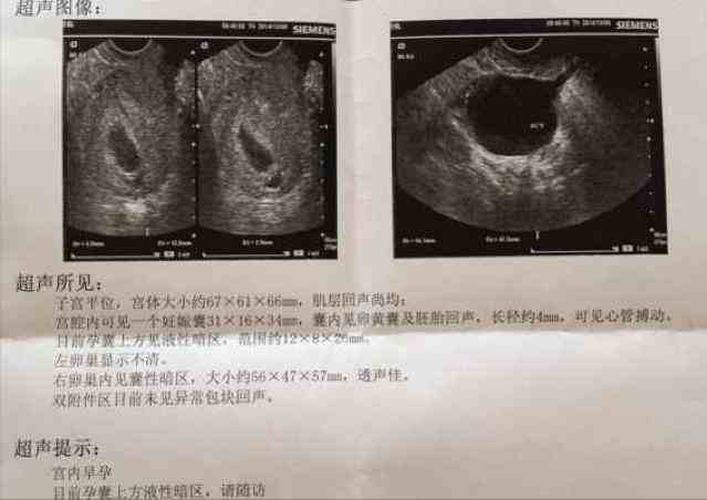 多久可以看到孕囊