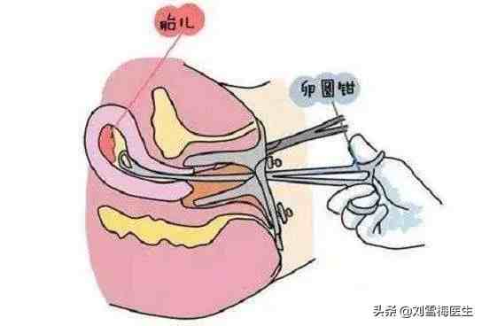 做完人流後多久可以懷孕懷孕了孕酮低對胎兒有什麼影響