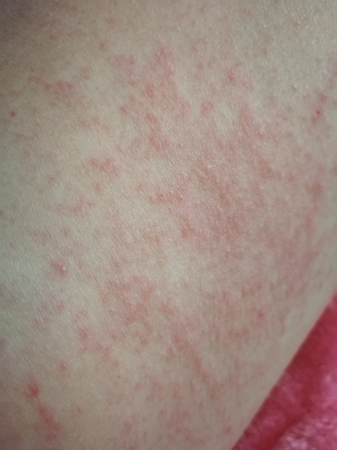 1,病情分析:湿疹是一种过敏性皮肤病,瘙痒是其主要症状之一