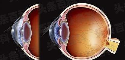 青光眼晶状体斑治斑块多少钱__青光眼晶状体综合征