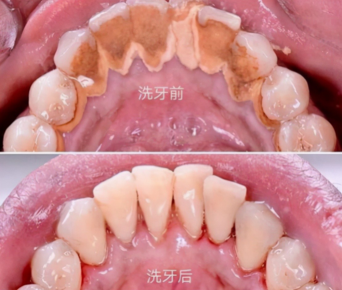 牙齿种植对身体健康有影响吗_牙齿种植的好吗_